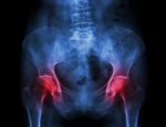 Film X-ray Pelvis Of Osteoporosis Patient And Arthritis Both Hip Stock Photo