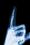 Film X-ray Index Finger And Hand ( Point A Finger ) Stock Photo