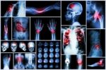 X-ray Multiple Disease (stroke (cerebrovascular Accident) : Cva ,pulmonary Tuberculosis ,bone Fracture ,shoulder Dislocation ,gout ,rheumatoid Arthritis ,spondylosis ,osteoarthritis ,bowel Obstruction Stock Photo