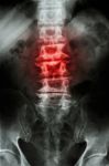 "spondylosis"  Film X-ray L-s Spine (lumbar-sacrum) Of Old Aged Patient And Inflammation At Spine Stock Photo