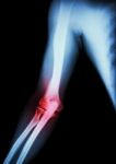 Arthritis At Elbow .  Film X-ray Of Arm , Elbow , Forearm And Inflammation At Elbow ( Gouty Arthritis , Rheumatoid Arthritis )  ( Black Background ) Stock Photo