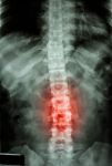 Film X-ray T-l Spine(thoracic-lumbar Spine) Show : Human's Thoracic-lumbar Spine And Inflammation At Lumbar Spine Stock Photo