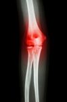 X-ray Human's Elbow And Arthritis (gout , Rheumatoid) Stock Photo