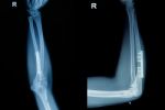 Film X-ray Wrist Fracture With Plate And Screw Stock Photo