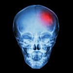 X-ray Skull Of Child And Stroke (cerebrovascular Accident) Stock Photo
