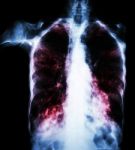 Pulmonary Tuberculosis  ( Film Chest X-ray :  Interstitial Infiltrate Both Lung Due To Mycobacterium Tuberculosis Infection ) Stock Photo