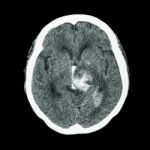 Ct Scan Of Brain : Show Hemorrhagic Stroke Stock Photo