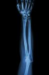 Fracture Distal Radius (wrist Bone) ,(colles' Fracture) Stock Photo