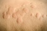 Skin Rash, Urticaria, Allergic Skin Reaction Stock Photo