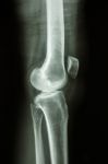 Normal Human's Knee Joint Stock Photo