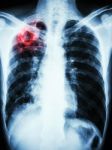 Mycobacterium Tuberculosis Infection (pulmonary Tuberculosis) Stock Photo