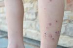 Allergic Dermatitis Stock Photo