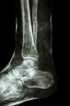 Fracture Shaft Of Fibula(leg's Bone) With Cast Stock Photo