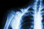 Fracture Right Clavicle Stock Photo