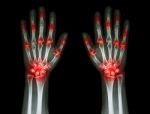 Multiple Joint Arthritis Both Hands ( Gout , Rheumatoid ) On Black Background Stock Photo