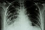 Pulmonary Tuberculosis ( Tb )  :  Chest X-ray Show Alveolar Infiltration At Both Lung Due To Mycobacterium Tuberculosis Infection Stock Photo