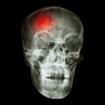 " Stroke (cerebrovascular Accident) "  X-ray Side Of Asian Skull Stock Photo