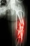 Film X-ray Show Comminute Fracture Shaft Of Femur (thigh Bone). It Was Spliced Stock Photo