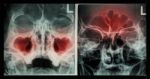Film X-ray Paranasal Sinus : Show Sinusitis At Maxillary Sinus ( Left Image ) , Frontal Sinus ( Right Image ) Stock Photo
