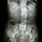 Spondylosis And Scoliosis ( Film X-ray Lumbar - Sacrum Spine Show Crooked Spine ) ( Old Patient ) ( Spine Healthcare ) Stock Photo