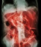 Bowel Obstruction ( X-ray Abdomen Supine Position : Large Bowel Stock Photo