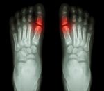 "rheumatoid Arthritis , Gouty Arthritis"  X-ray Child's Foots And Arthritis At Metatarsophalangeal Joint (big Toe Area) Stock Photo