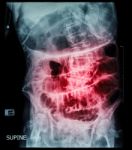 Small Bowel Obstruction ( Film X-ray Abdomen ( Supine Position ) : Show Small Bowel And Stomach Dilate ) ( Step Ladder Pattern ) Stock Photo