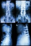 "spondylosis And Spondylolisthesis"  It Was Operated And Internal Fixed At Spine (left Image : Before Operated) (right Image : After Operated) Stock Photo