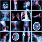 Set Of X-ray Multiple Part Of Human,multiple Disease,orthopedic,surgery (stroke,bone Fracture,orthopedic Operation,kidney Stone,arthritis,gout,pulmonary Tuberculosis,heart Disease,scoliosis,etc) Stock Photo