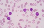 Bone Marrow: Myeloblasts With Auer Rods Seen In Acute Myeloid Le Stock Photo