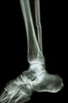 Complete Fracture Shaft Of Fibula (leg's Bone) Stock Photo