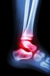 Film X-ray Child's Ankle And Arthritis At Ankle (rheumatoid) Stock Photo