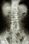 Bent Lumbar Spine And Spurs Of Old People Stock Photo