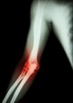 Arthritis At Elbow .  Film X-ray Of Arm , Elbow , Forearm And Inflammation At Elbow ( Gouty Arthritis , Rheumatoid Arthritis )  ( Black Background ) Stock Photo