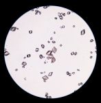 Uric Acid Crystal In Urine Sediment Stock Photo