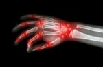 Rheumatoid Arthritis , Gouty Arthritis ( Film X-ray Hand Of Child With Arthritis At Multiple Joint ) Stock Photo