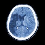 Ct Brain : Show Ischemic Stroke (hypodensity At Right Frontal-pa Stock Photo