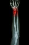 Fracture Distal Radius (wrist Bone) ,(colles' Fracture) Stock Photo