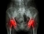 Film X-ray Pelvis Of Osteoporosis Patient And Arthritis Both Hip Stock Photo