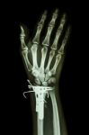 Fracture Distal Radius (forearm's Bone). It Was Operated And Ins Stock Photo