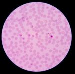 Blood Films For Malaria Parasite.showing Pink Cells Malaria Pigm Stock Photo