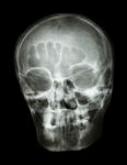 X-ray Skull(oblique) Of Thai People Stock Photo