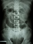 "small Intestine Obstruction"  Film X-ray Abdomen Supine : Show Stock Photo