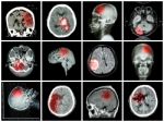 Collection Of Brain Disease ( Ct Scan And Mri Of Brain : Show Cerebral Infarct , Intracerebral Hemorrhage , Brain Tumor , Basal Ganglia Hemorrhage ( Status Post Craniotomy ) ) ( Health Care Concept ) Stock Photo
