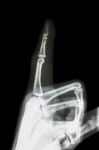 Film X-ray Index Finger And Hand ( Point A Finger ) Stock Photo