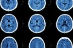 Ct Scan Of Brain Show Normal Brain ( Neurological Background ) Stock Photo