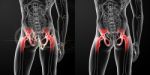 3d Rendering Medical Illustration Of A Painful Hip Joint Stock Photo