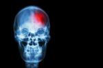 Stroke ( Cerebrovascular Accident ) . Film X-ray Skull Of Human With Red Area ( Medical , Science And Healthcare Concept And Background ) Stock Photo