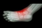 Arthritis And Injury At Ankle  :  Film X-ray Of Child 's Foot ( Side View ) ( Lateral ) Stock Photo