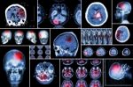 Set , Collection Of Brain Disease ( Cerebral Infarction , Hemorrhagic Stroke , Brain Tumor , Disc Herniation With Spinal Cord Compression ,etc)( Ct Scan , Mri , Mrt )( Neurology And Nervous System ) Stock Photo
